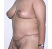 Body and Thigh Lifts Body and Thigh Lifts