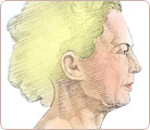 Facelift Surgery 1