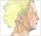 Facelift Surgery 2