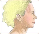 Facelift Surgery 4