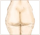 Liposuction Cosmetic Surgery 1