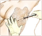 Liposuction Cosmetic Surgery 3