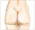 Liposuction Cosmetic Surgery 4