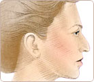 Rhinoplasty Surgery 1