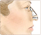 Rhinoplasty Surgery 2