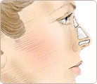 Rhinoplasty Surgery 3