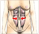 Abdominal muscle tightening