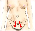 Excess skin removal