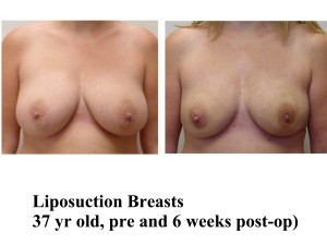 Liposuction for Breast Reduction
