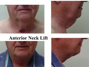 Anterior Neck Lift Option for Facelift Surgery Scars