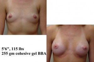 cohesive gel breast implant toronto