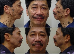 Facial Rejuvenation Surgery