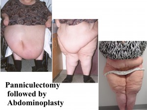 Panniculectomy is performed to manage serious complications from abdominal apron