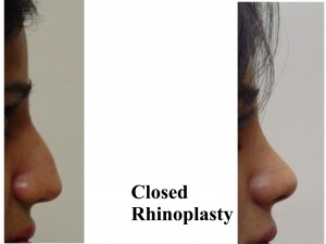 Dorsal Hump Reduction : Closed Rhinoplasty