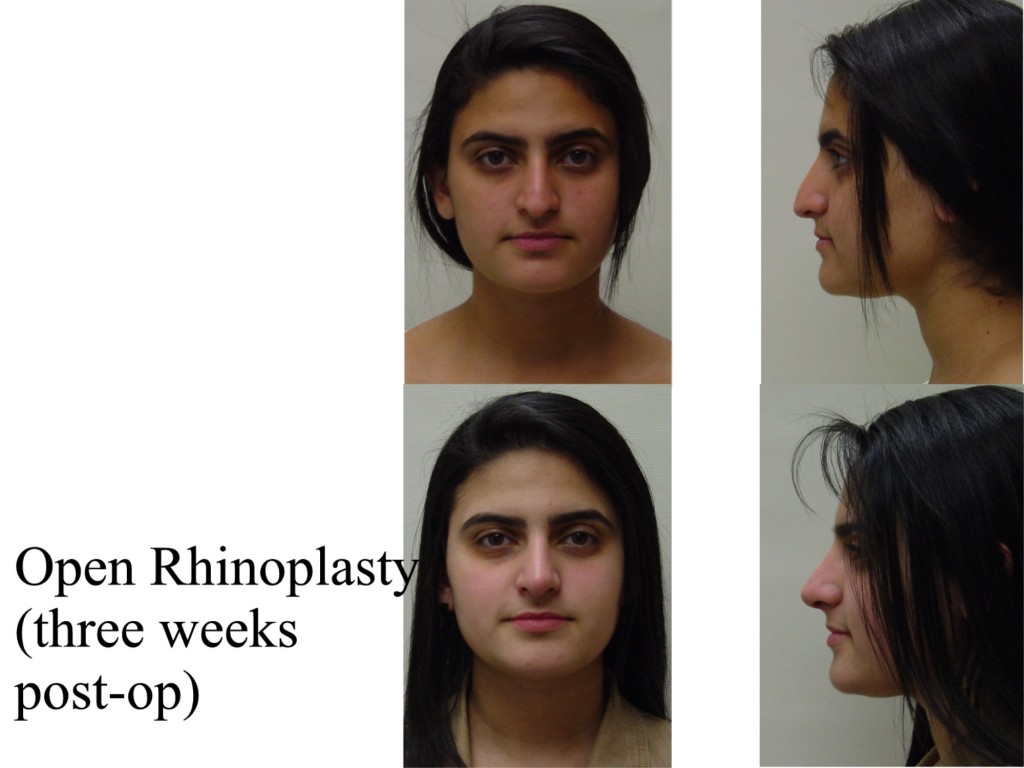 Rhinoplasty: Closed vs. Open