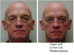 Upper and Lower Lid Blepharoplasty