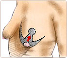 Breast Lift Surgery 2