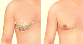 Gynecomastia Surgery