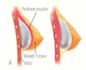 Breast Augmentation Operation