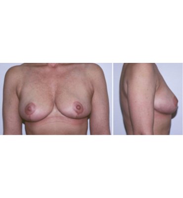 Breast Reduction After