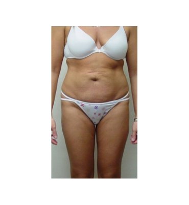 Skin Excess After Liposuction