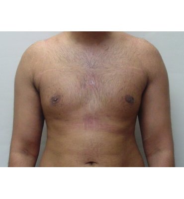 Gynecomastia Correction 