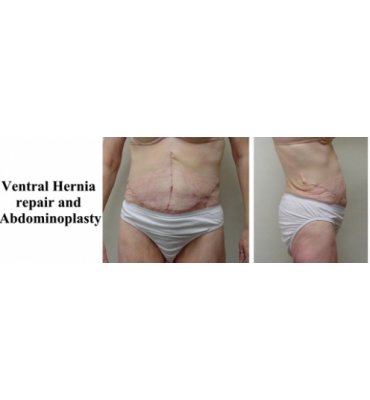 Ventral Hernia Repair And Abdominoplasty After