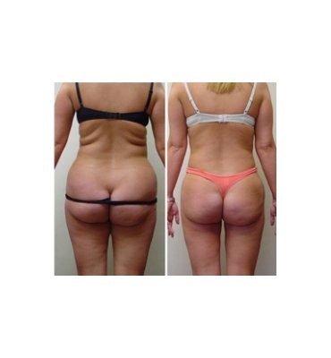 After Liposuction Results