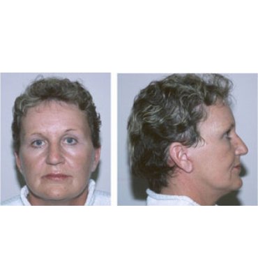 Simplified Face Rejuvenation Procedures After