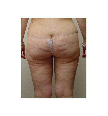Cellulite And Liposuction After