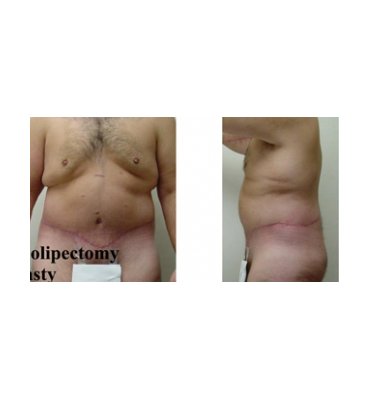 Body Contour Surgery-Single Stage After