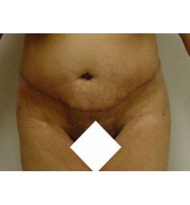 Tummy Tuck Procedure And Stretch Marks After