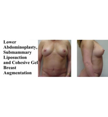 Liposuction & Cohesive Gel Breast Augmentation After