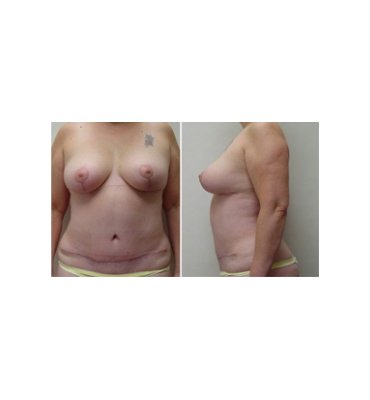 Mastopexy And Abdominoplasty After
