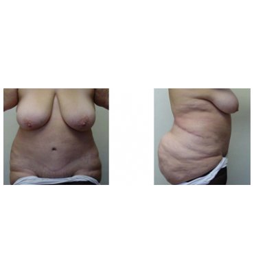 Body Contour Surgery-Customized After