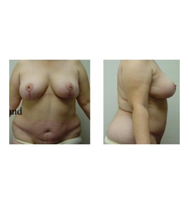 After Body Contour Surgery When Overweight