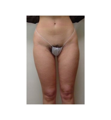 Liposuction Abdomen & Thighs After