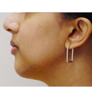 Chin Implant & Rhinoplasty After