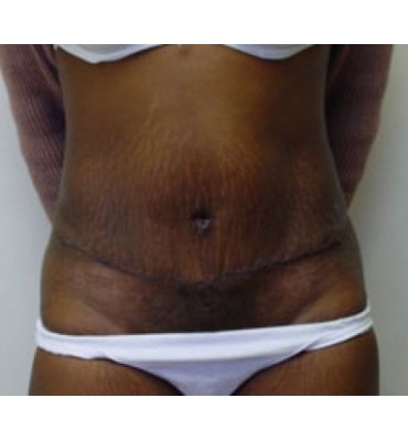 Tummy Tuck And Mons/Anterior Thigh After