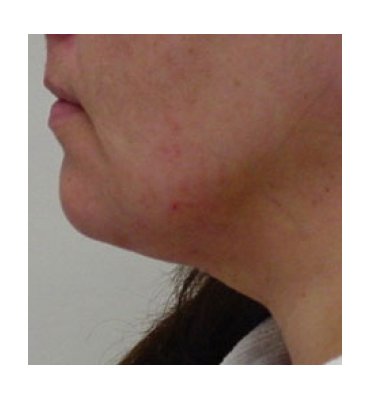 Liposuction Neck After
