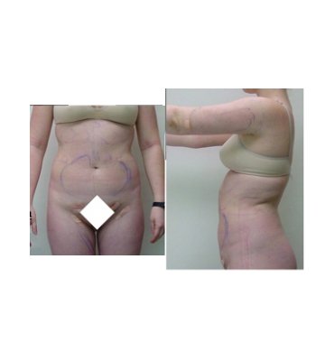 After Liposuction Surgery