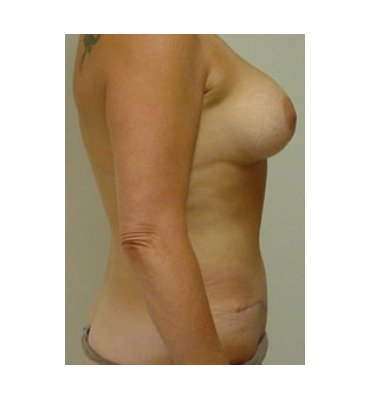 Combined Tummy Tuck And Breast Augmentation Surgery After