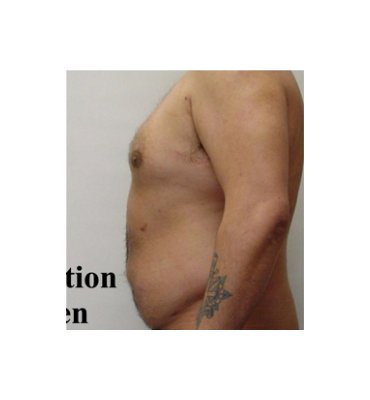 Weight Gain After Liposuction