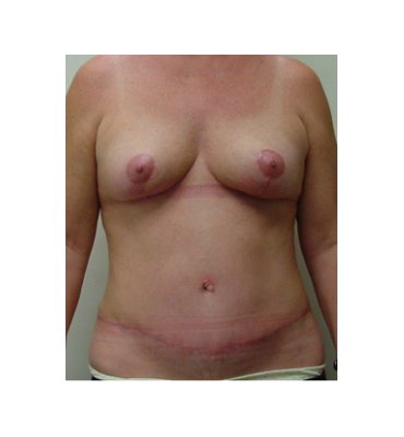 Tummy Tuck & Breast Lift After