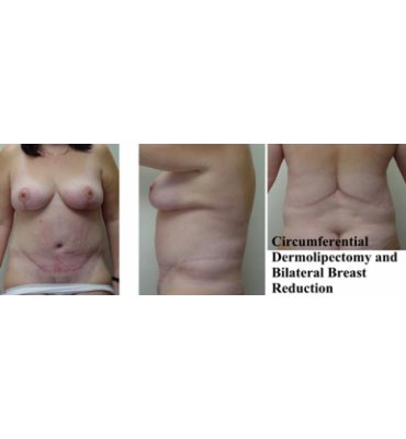 Combination Body Contour Surgery After