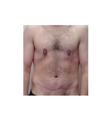 Male Breast Reduction After Weight Loss