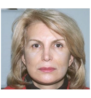 Effects Of Facial Rejuvenation Treatments After