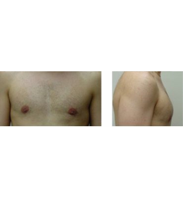 After Combination Treatment For Male Breast Enlargement