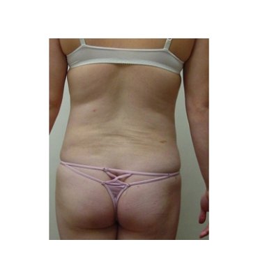 Liposuction Hips & Thighs After