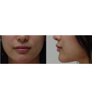 Lip Augmentation After